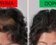 STOP alla CADUTA dei CAPELLI, FAI COSÌ