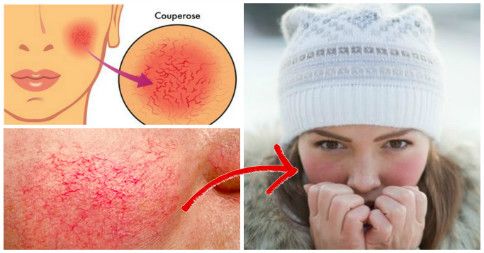 ROSSORI DEL VISO e COUPEROSE: Come combatterli davvero