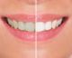 Come eliminare i denti gialli ed avere un sorriso splendente