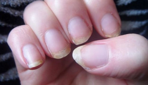Quello che le tue unghie dicono sul tuo stato di salute