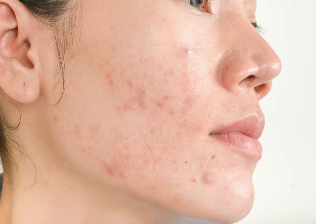 cosa causa i punti neri e l'acne?