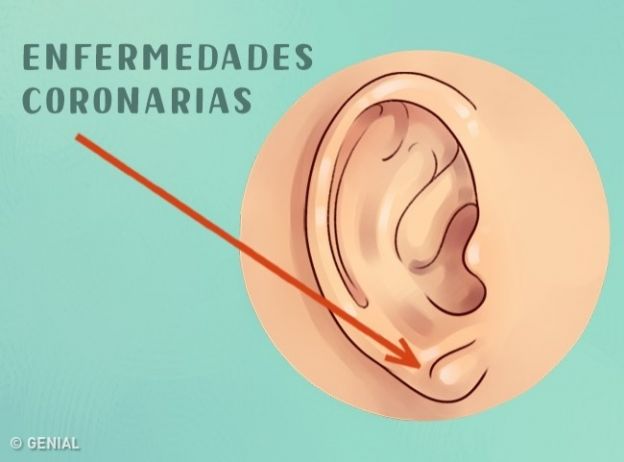 Malattie Coronarie
