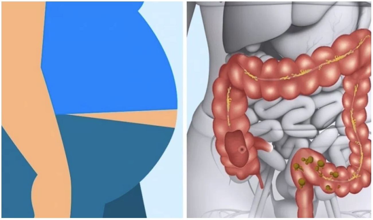 Может ли из за желудка болеть кишечник. Лекарство для желудка. Может ли из за желудка болеть кишечник. Кишечник и вздутие живота. Болят кишки внизу живота.